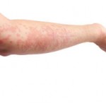 ¿Se puede tratar la Psoriasis con Aceite de Argán?