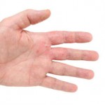 ¿Puede servir el Aceite de Argán de Marruecos para tratar el Eczema?